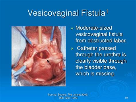 Vaginal Fistula Symptoms