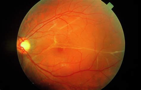 Endolaser Retinopexyendoscopy Vitreous Retina Macula Consultants Of