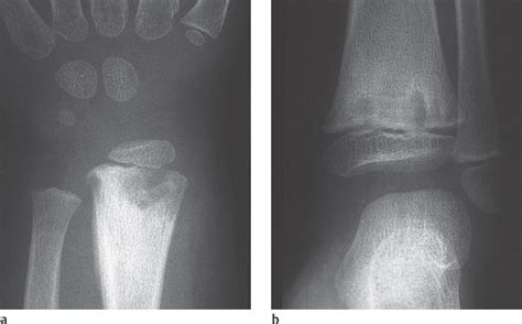 41 Osteomyelitis Radiology Key