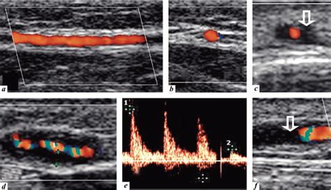 Duplex Ultrasound Of The Temporal Arteries A Longitudinal View Of A