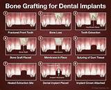 Emergency Dental Implants Images