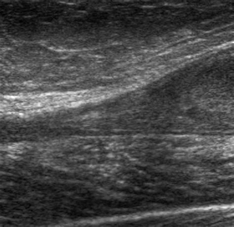 Isolated Tear Of The Tendon To The Medial Head Of Gastrocnemius