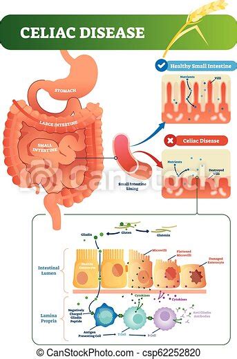 Celiac Disease Vector Illustration Labeled Diagram With Its Structure