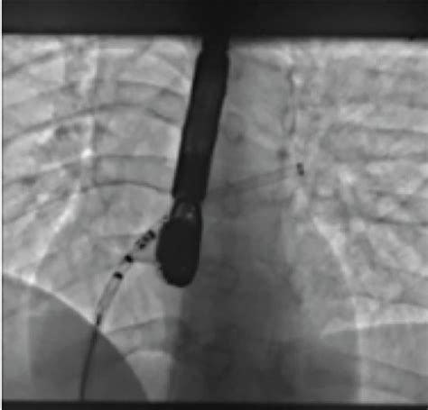Ac Cardia Ultrasept Pfo 20 Mm Device Implantation Download