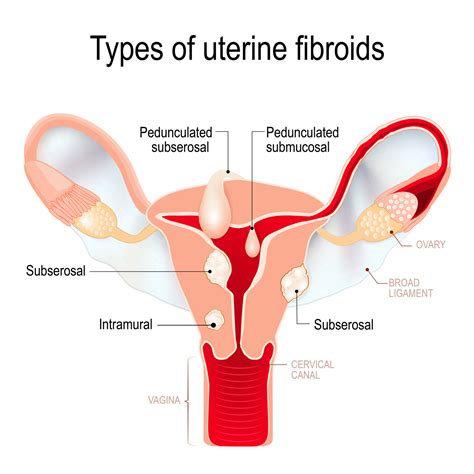 Uterine Fibroids International Women S Clinic