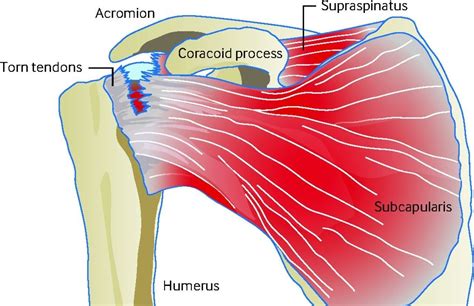 Tutorials on the shoulder muscles (e.g rotator cuff muscles: Diagram Of Shoulder Tendons Supraspinatus Muscle Wikipedia | Supraspinatus muscle, Rotator cuff ...