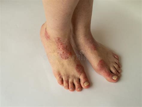 Closeup Of The Legs Of A Woman Suffering From Chronic Psoriasis On A