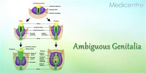 Ambiguous Genitalia Diagram