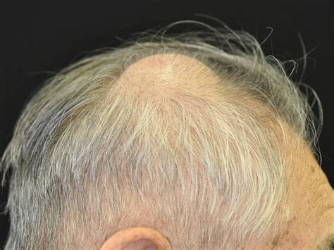 Two Cases Of Metastases To The Scalp Bone Mimicking Epidermoid Cyst