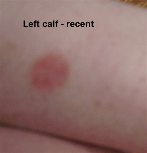 Collection 96 Pictures Red Rash On Lower Legs Above Ankles Photos Full