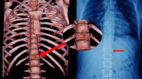 Ct Scan Thoracic Spine 3d And X Ray Thoracic Spine Finding Fracture T11