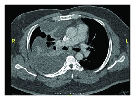 Chest Ct Showing The Encysted Pleural Effusion Download Scientific