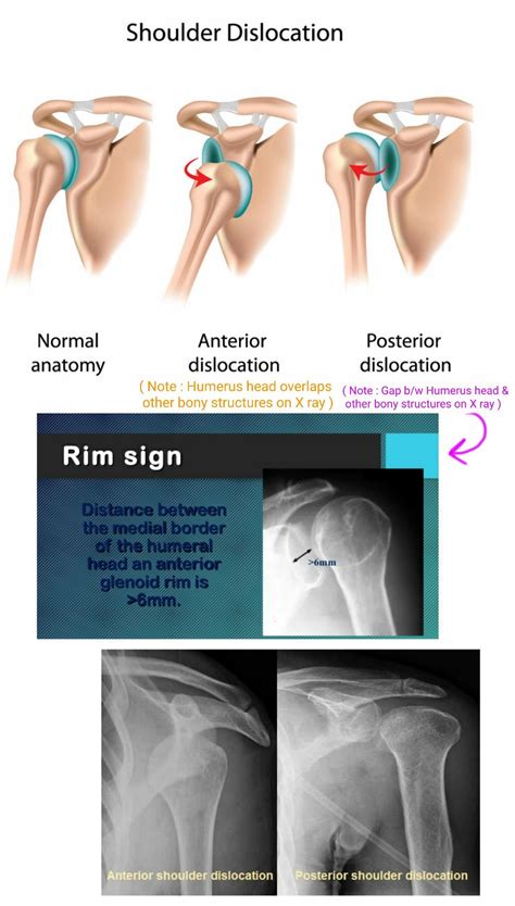 Anterior Vs Posterior Shoulder Dislocation On X Ray With Images