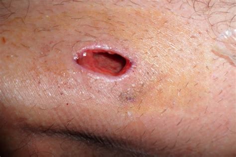 If infection ensues, the cyst will cause further pain and may have a discharge. Effective Tips for Treating Ingrown Hair (Graphic Photos ...