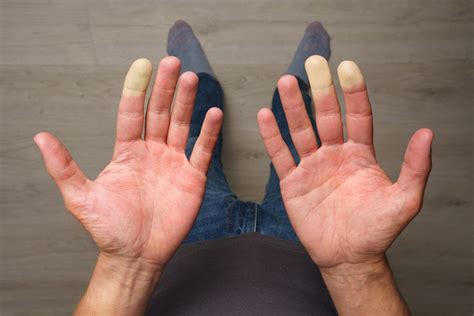 Raynauds Syndrome Symptoms And Treatment Options Wwmg Blog