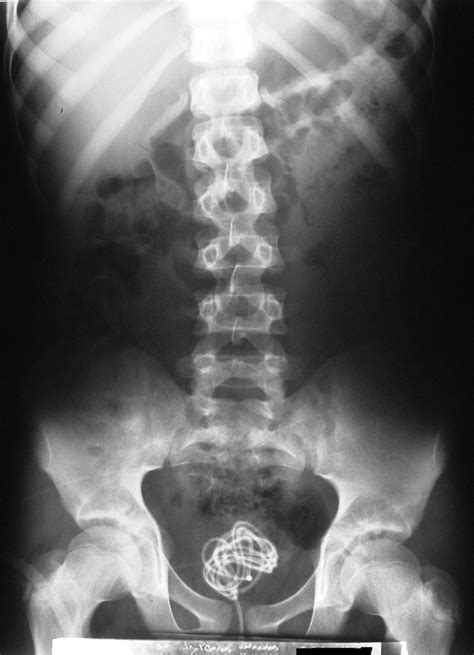 Management Of An Extremely Long Foreign Body In The Urethra And Bladder