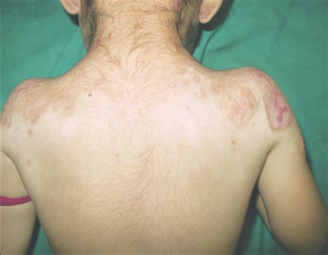Multiple Atrophic Scars Of Various Sizes Over The Upper Back And Arms