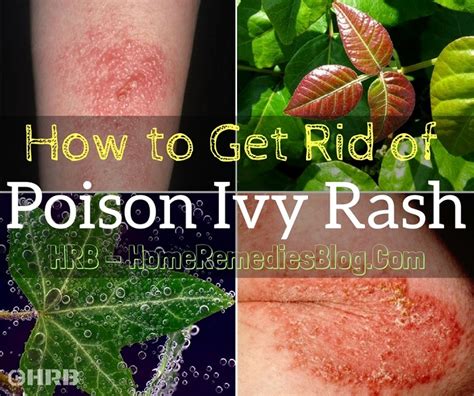 How To Get Rid Of Poison Ivy Rash 14 Fast Home Remedies Home