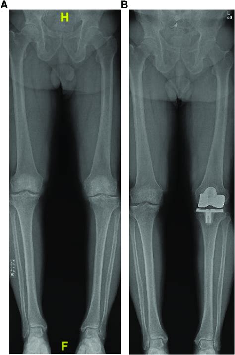 A Example Of Pre Operative Standing Long Leg Radiograph Showing