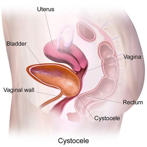 What Is The Difference Between Cystocele And Rectocele Compare The