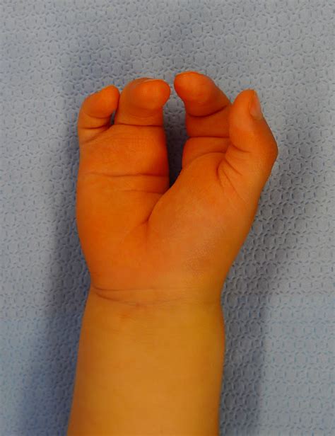 Cleft Hand Surgery Congenital Hand And Arm Differences