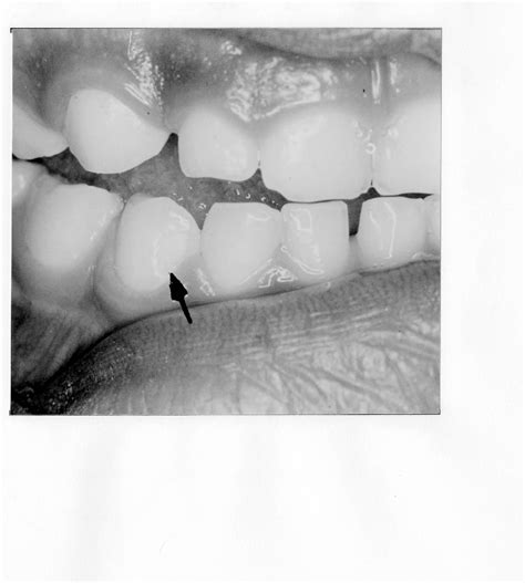 Figure 2 From Localized Enamel Hypoplastic Spots On The Labial Surfaces