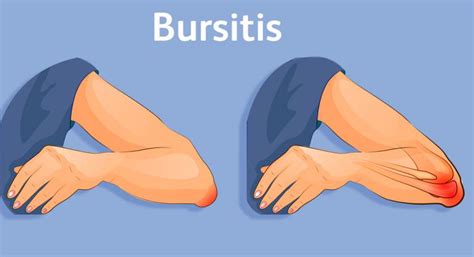 Tipos De Bursitis Y Cómo Prevenirlas Ejercicio Y Deporte