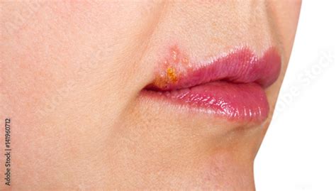 Herpes On The Lip Close Up Macro Stockfotos Und Lizenzfreie Bilder