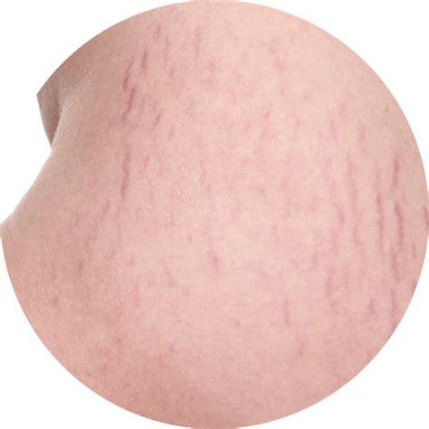 About Stretch Marks