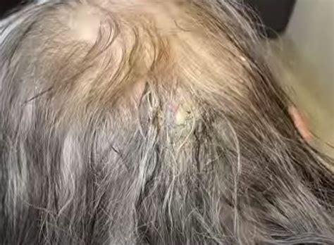 Cyst On Scalp Painful To Touch Archives New Pimple Popping Videos