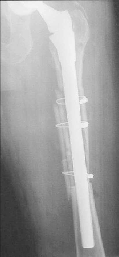 Anteroposterior Radiograph Of The Left Femur Immediately Following