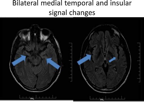 Medial Temporal Lobe Signal Changes In Mri Download Scientific Diagram
