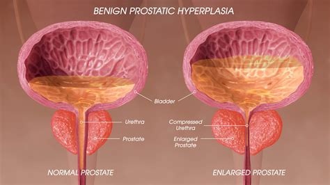 prostate enlargement expert ir vein and vascular clinic