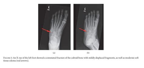 Nutcracker Cuboid Fracture A Case Report And Review Document Gale