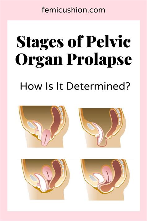 Pelvic Organ Prolapse Classification And Scoring Systems Pelvic Organ Prolapse Pelvic Organ