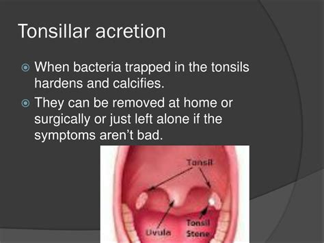 Ppt Tonsillitis Powerpoint Presentation Free Download Id2152221