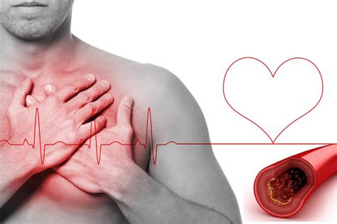 Infarto Agudo Al Miocardio Causas Síntomas Y Tratamietno La Guía De