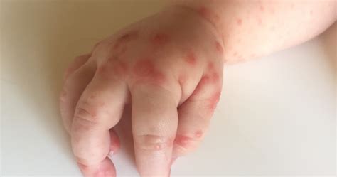 What Does Hand Foot Disease Look Like