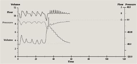 Figure 1 From Pulmonary Effects Of ‘lung Packing By Buccal Pumping In