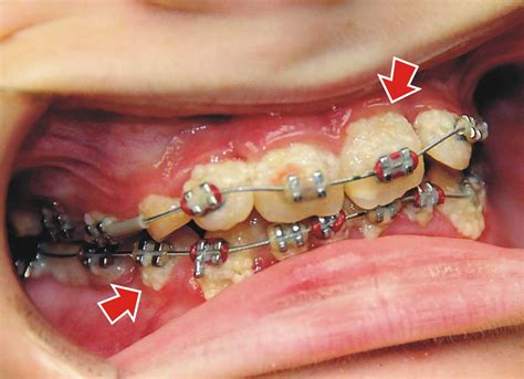 Calcium Spots On Teeth Braces Teeth Bonding