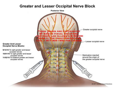 Amicus Illustration Of Amicusmedicalgreaterlesseroccipitalnerve