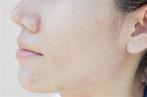 Skin Problems And Dark Spots Scar From Acne On Face Premium Photo