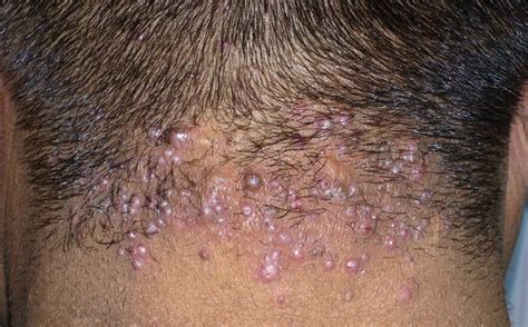 Acne Keloidosis Pimples On Scalp Neck Pimples Head Acne