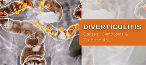 Diverticulitis Causes Symptoms And Treatments Dr Deetlefs Cpt