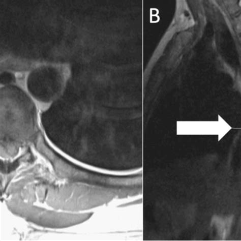 Preoperative T Weighted Mri In A Axial And B Sagittal Views
