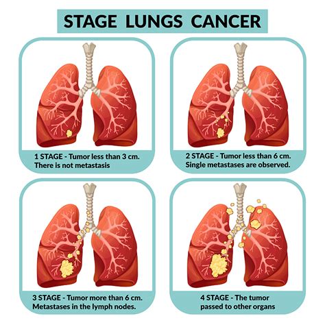 Lung Cancer Staging Prognosis Infographics Lung Cancer Treatment Cell Non Nsclc