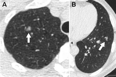 Representative Examples Of Subsolid Nodules A B Axial Ct Images