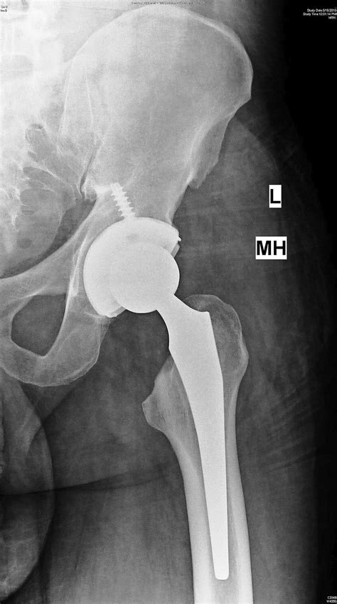 Cureus An Unusual Cause Of Fever In A Patient With Total Hip Replacement