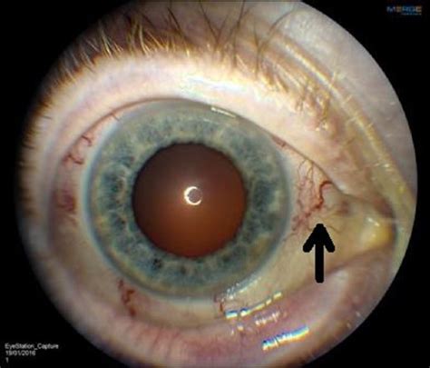 Visible Engorged And Dilated Scleral Blood Vessels On The