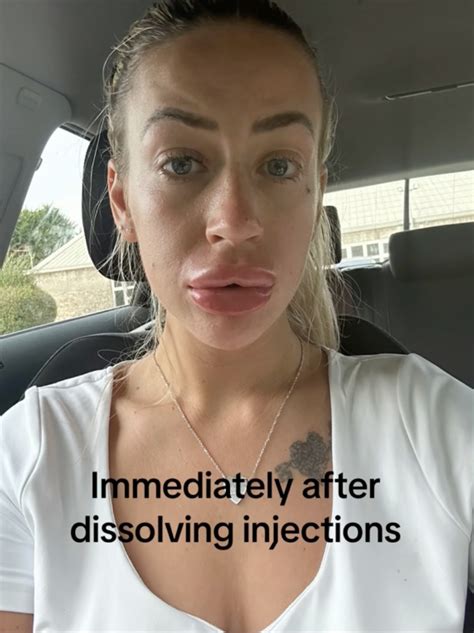 I Had My Filler Dissolved But My Lips Ballooned Beware This Allergic Reaction